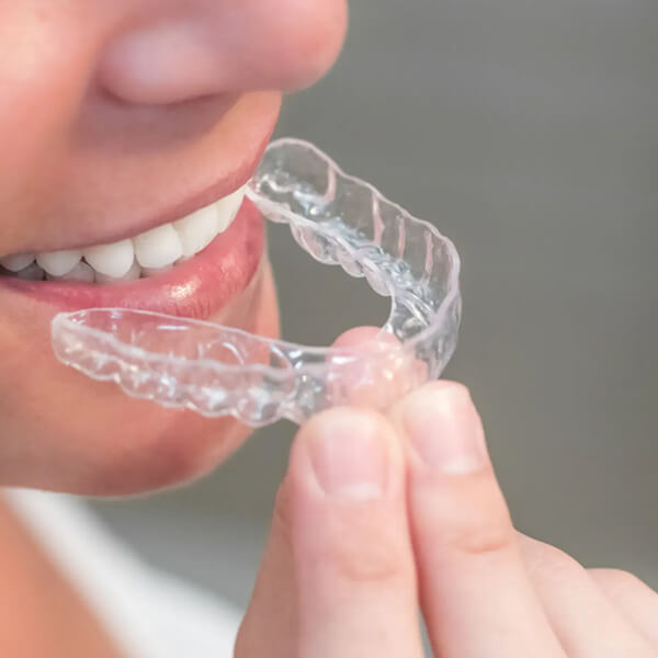 custom-oral-appliance-fabrication