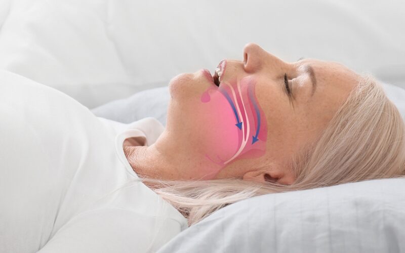 obstructive sleep apnea concept